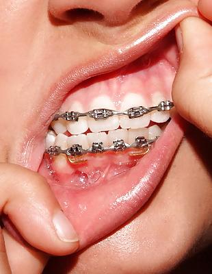 18P Cum on My Braces, Mister 2