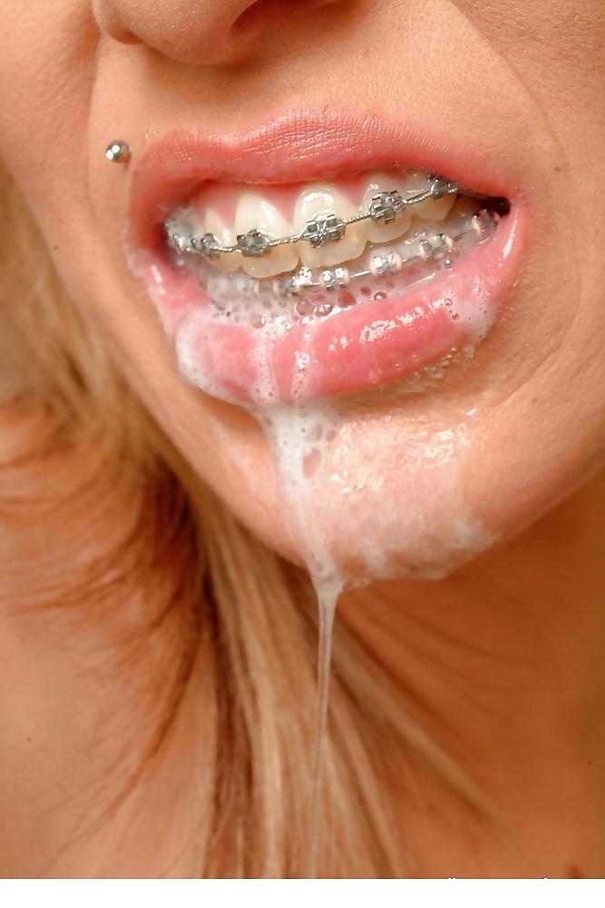 25P Braces