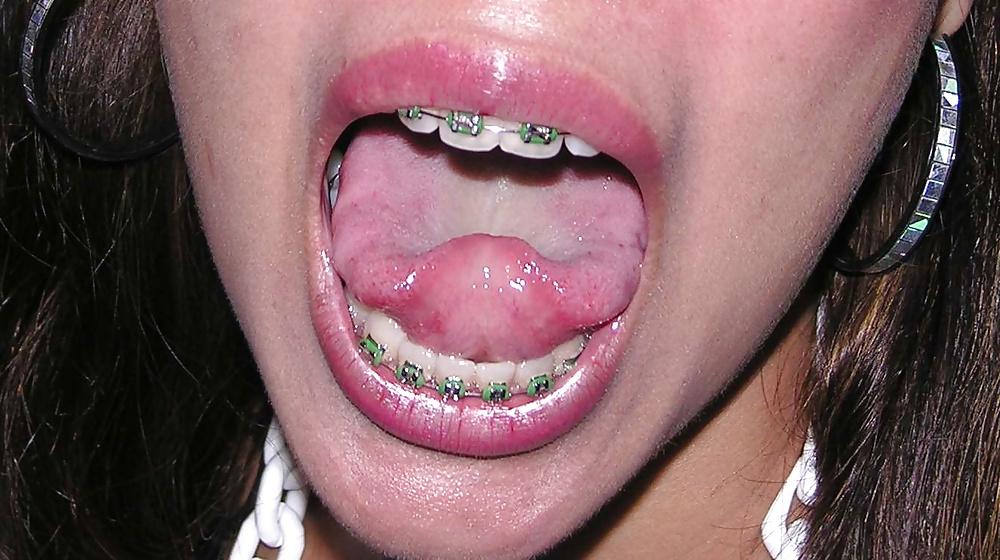 25P Braces