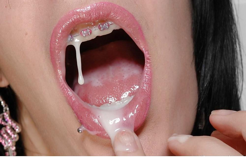 25P Braces