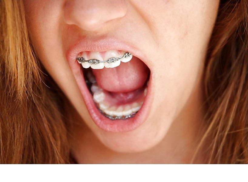 25P Braces