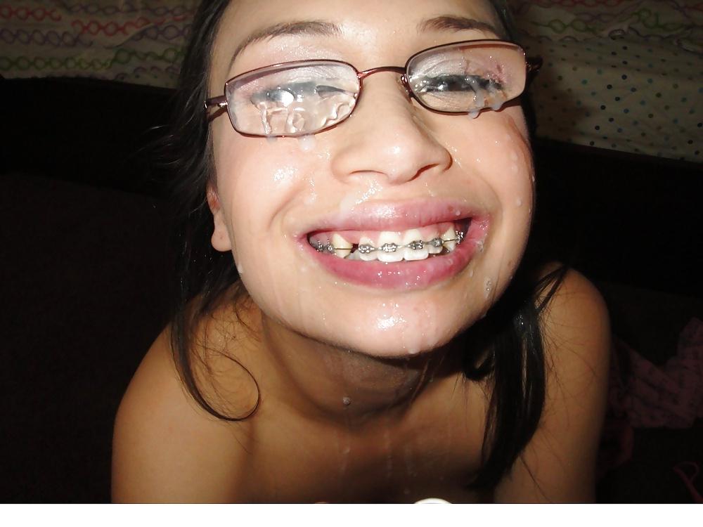 25P Braces