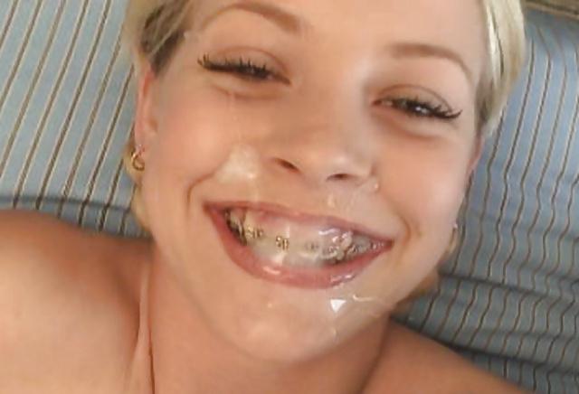 25P Braces