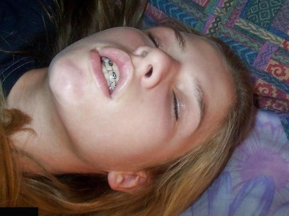 25P Braces