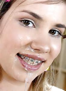 13P There is something on your braces