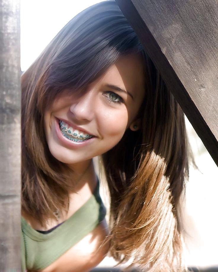 25P Teens With Braces 2
