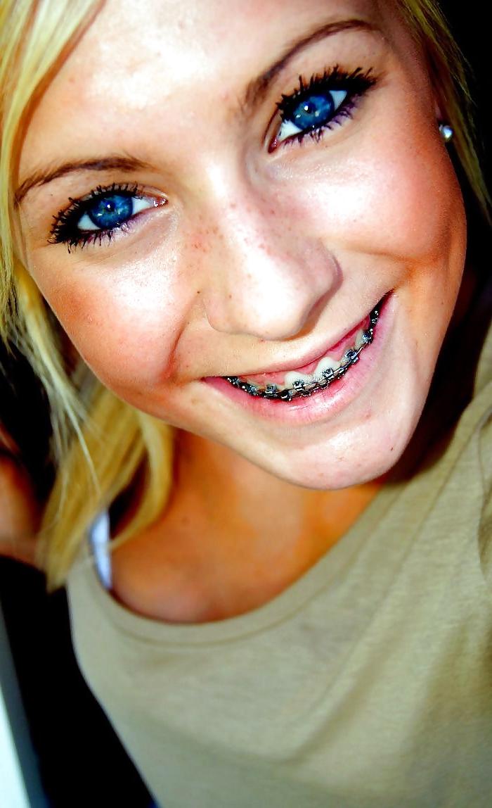 25P Teens With Braces 2