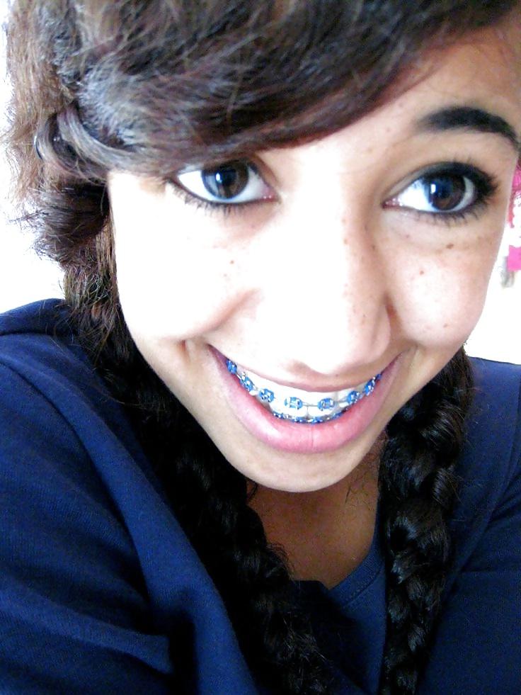 25P Teens With Braces 2