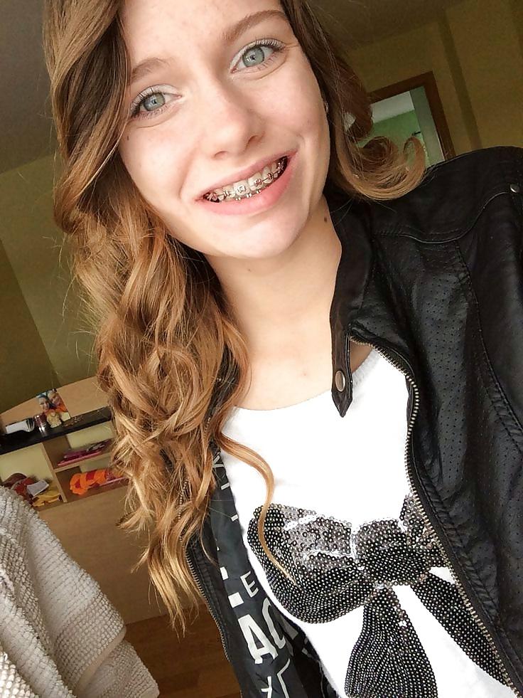 25P Teens With Braces 2