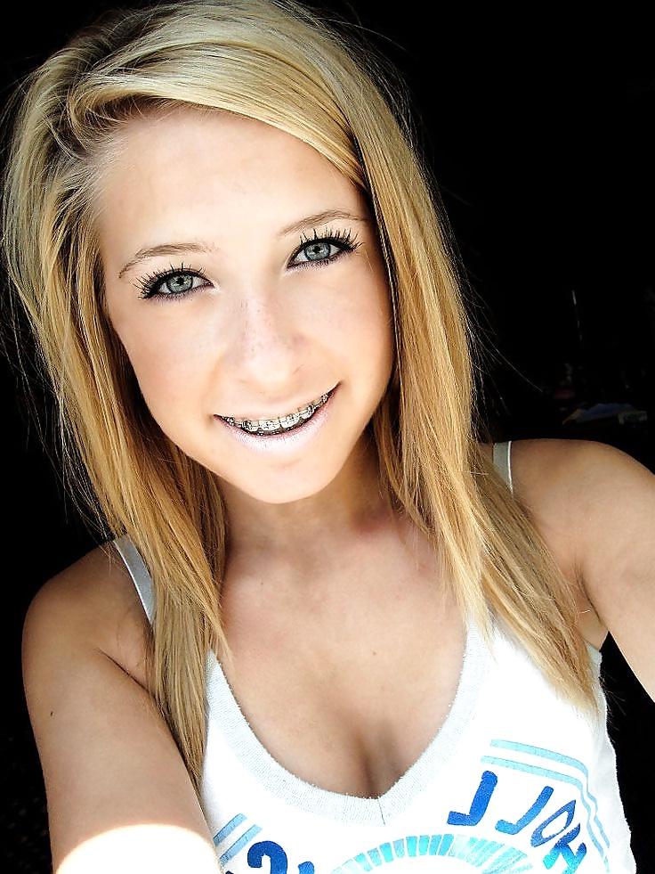25P Teens With Braces 2