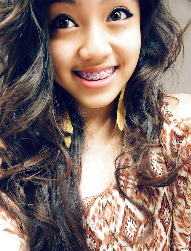 25P Teens With Braces 2