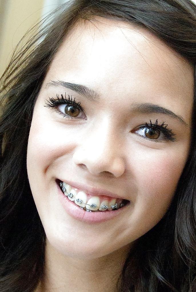25P Teens With Braces 2