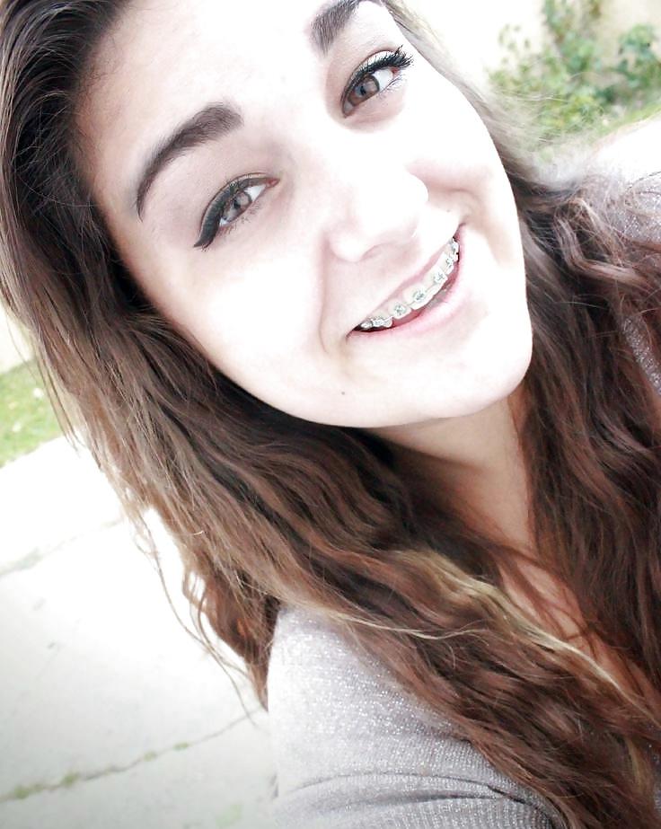 25P Teens With Braces 2