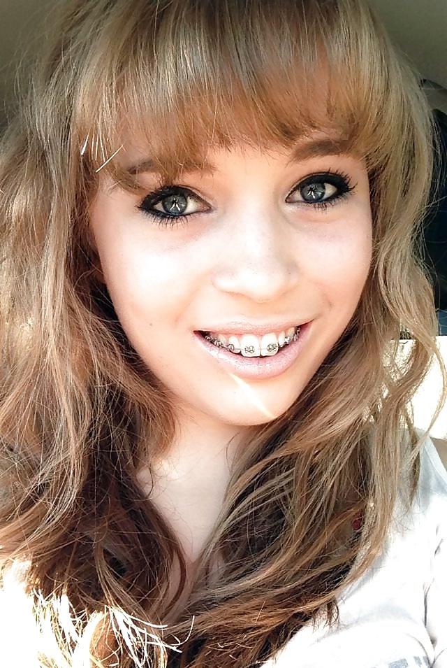 25P Teens With Braces 2