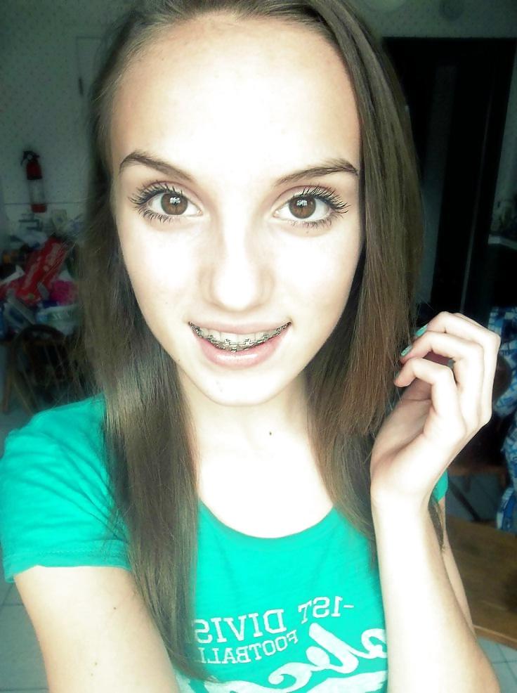25P Teens With Braces 2