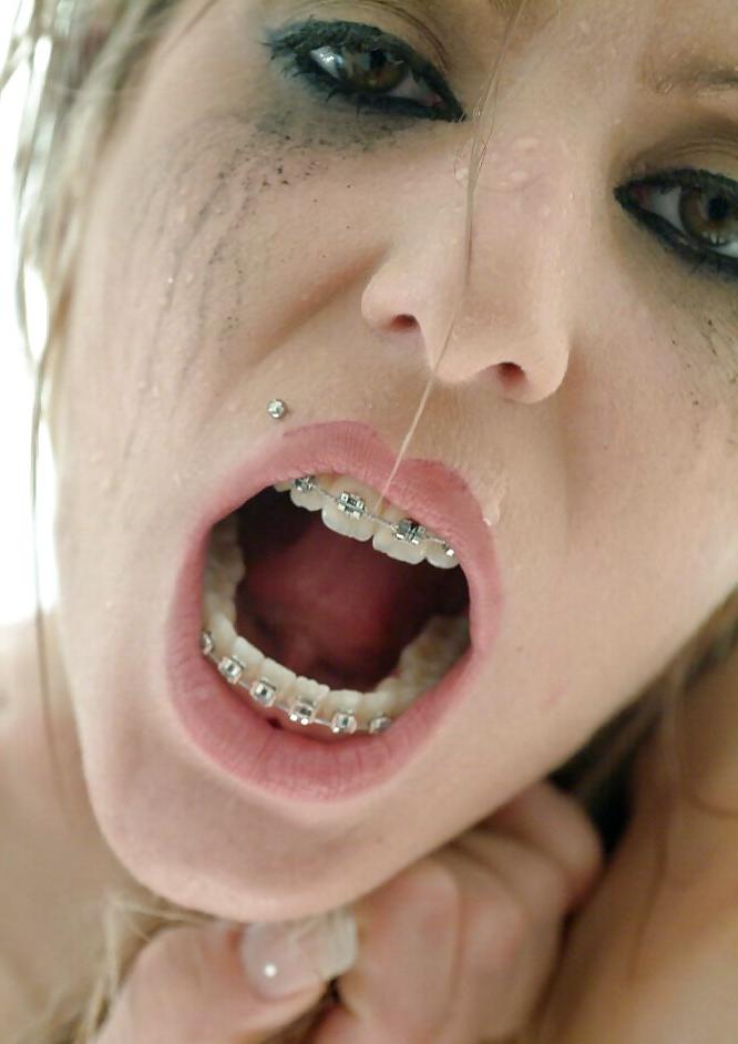 25P Whores With Braces