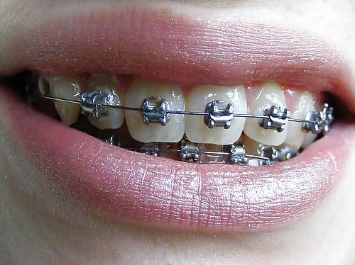 6P Cum on My Braces, Mister 