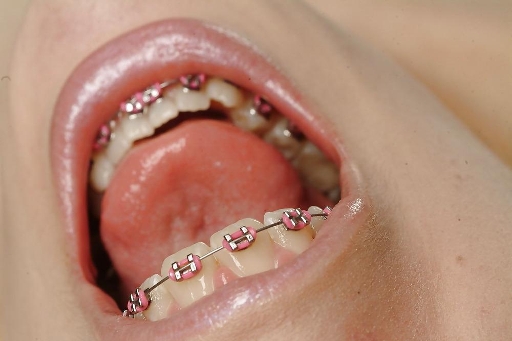 6P Cum on My Braces, Mister 