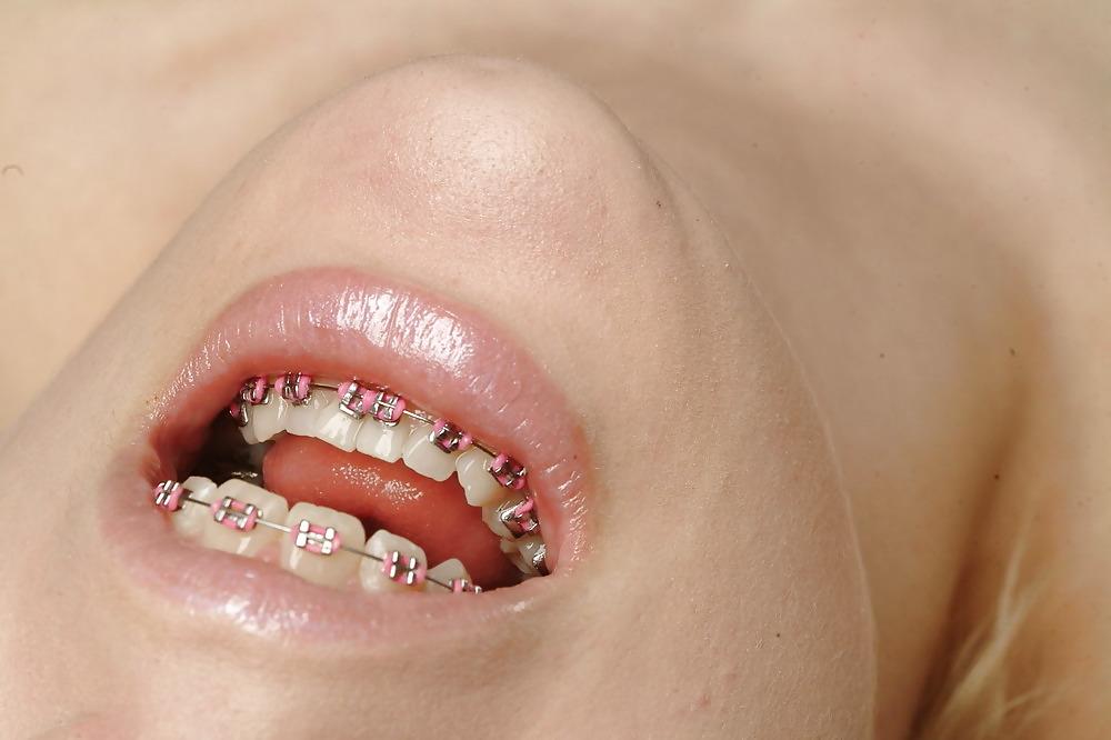 6P Cum on My Braces, Mister 
