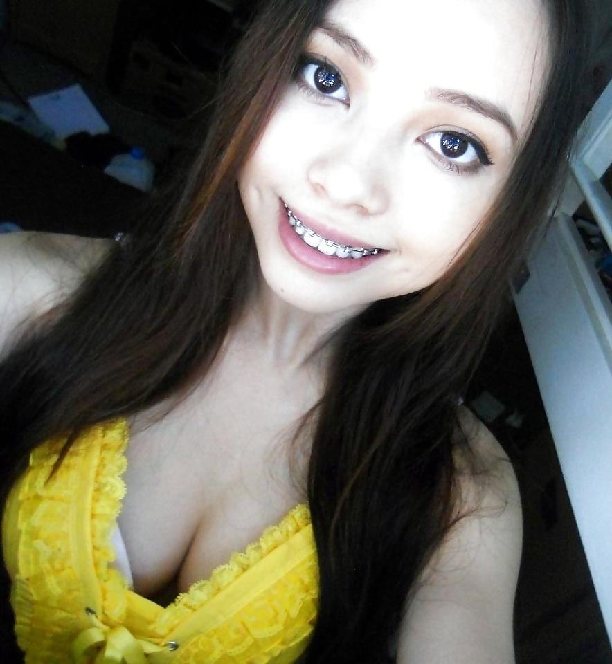 25P Teenager mit Zahnspange 4