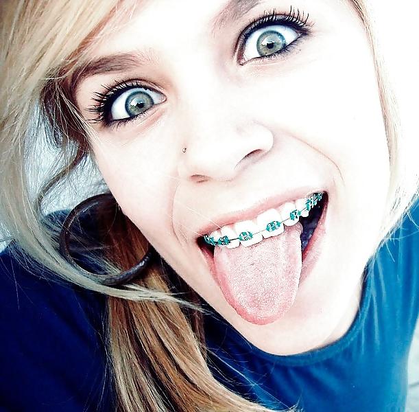 25P Teenager mit Zahnspange 4
