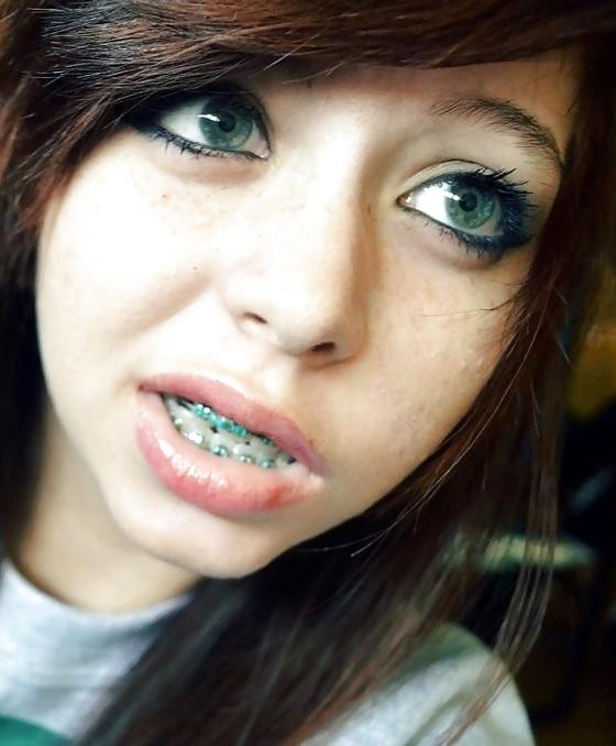 25P Teenager mit Zahnspange 4