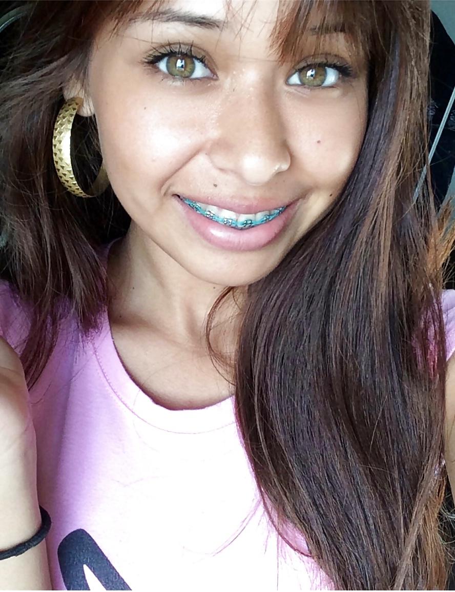 25P Teenager mit Zahnspange 4