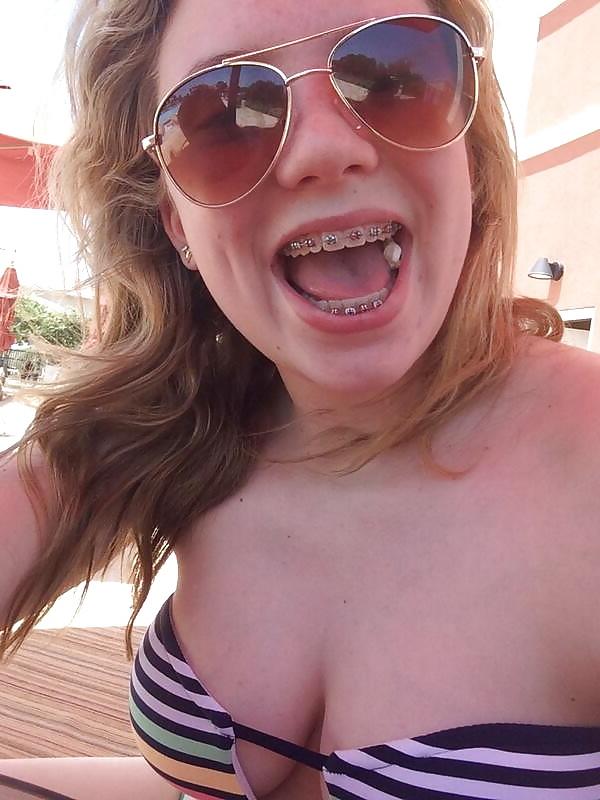 25P Teenager mit Zahnspange 4