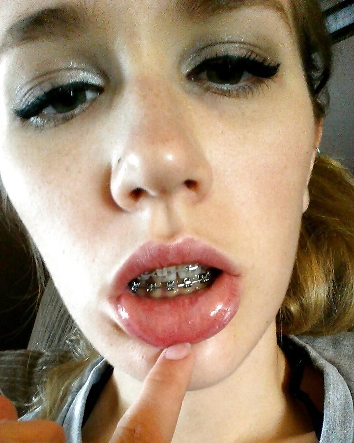 25P Teenager mit Zahnspange 4