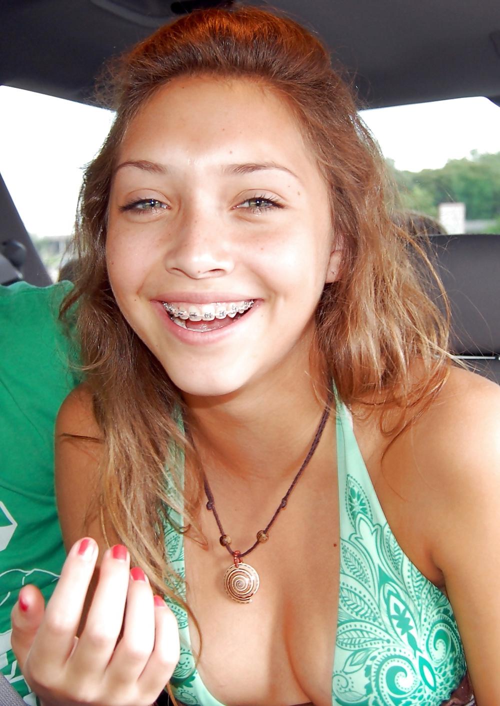 25P Teenager mit Zahnspange 4