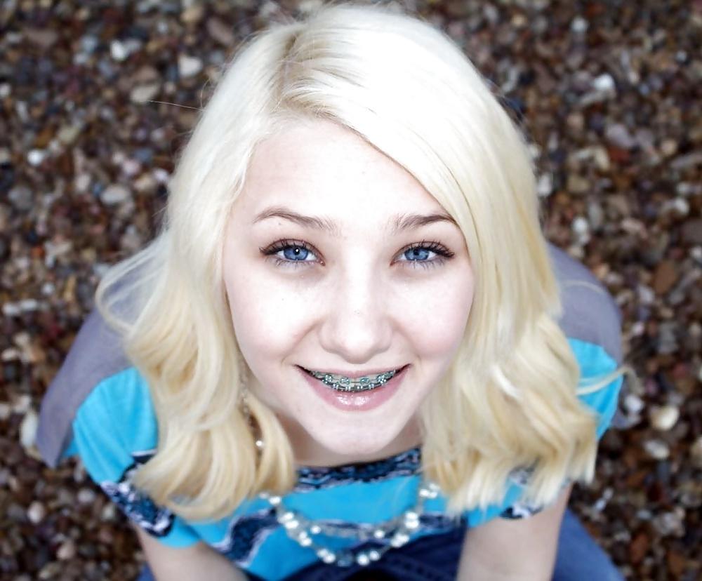 25P Teenager mit Zahnspange 4