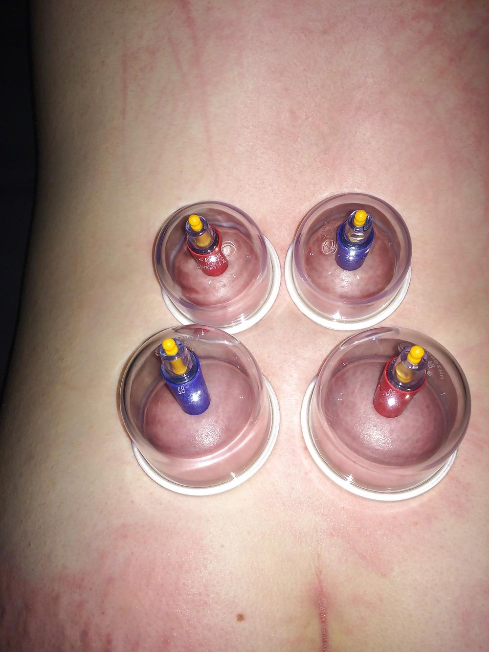 5P Japanese suction cups massage therapy 