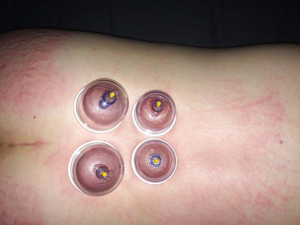 5P Japanese suction cups massage therapy 