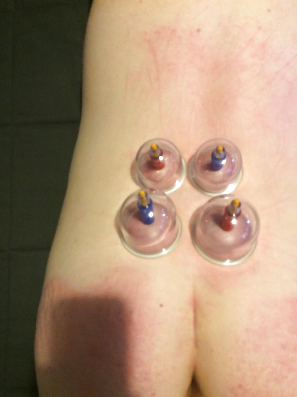 5P Japanese suction cups massage therapy 