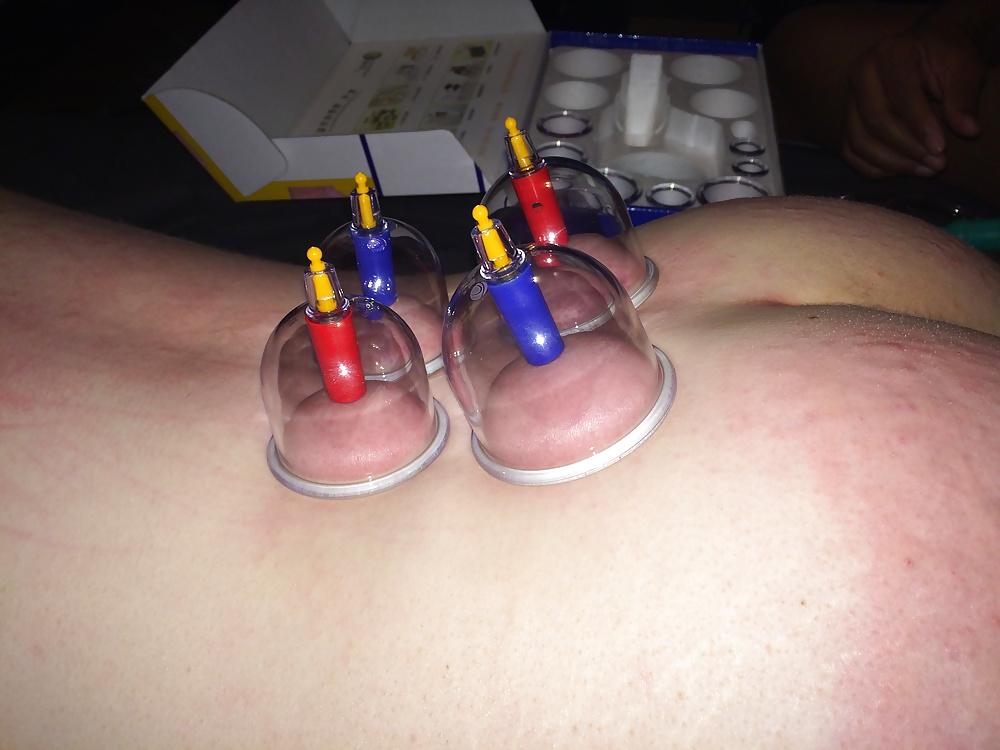 5P Japanese suction cups massage therapy 
