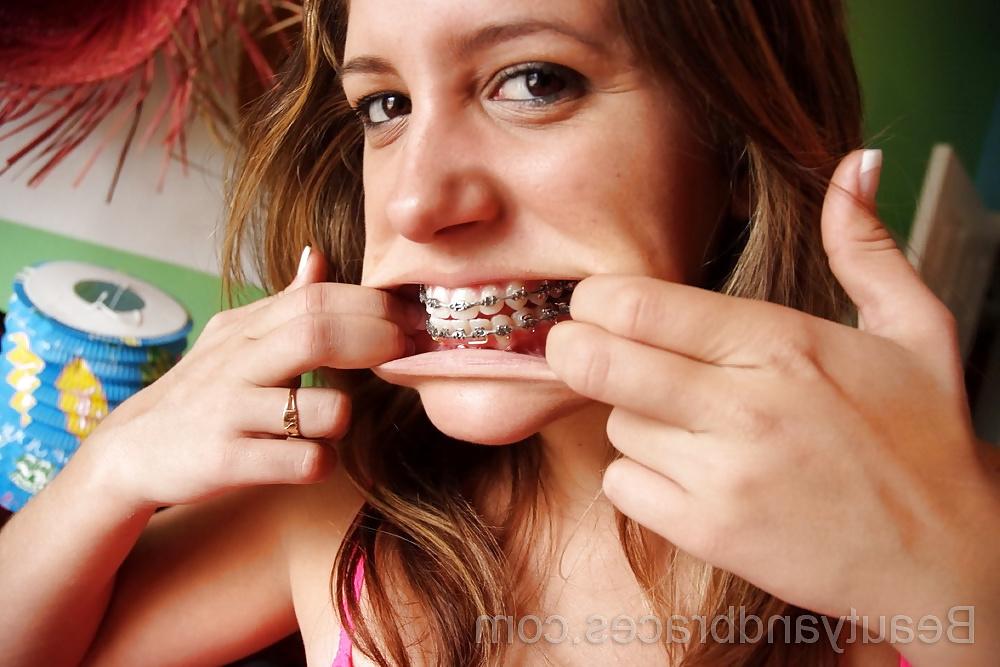 25P BRACES 