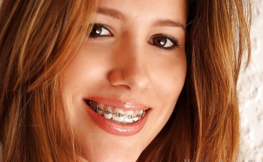 25P BRACES 