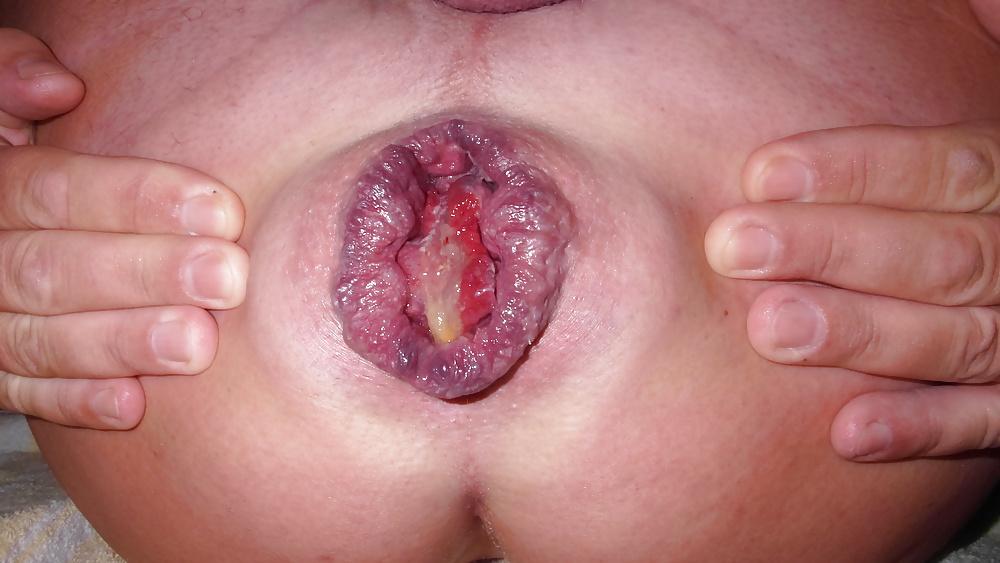 12P Asshole extrem prolapse - Rosebud gape II