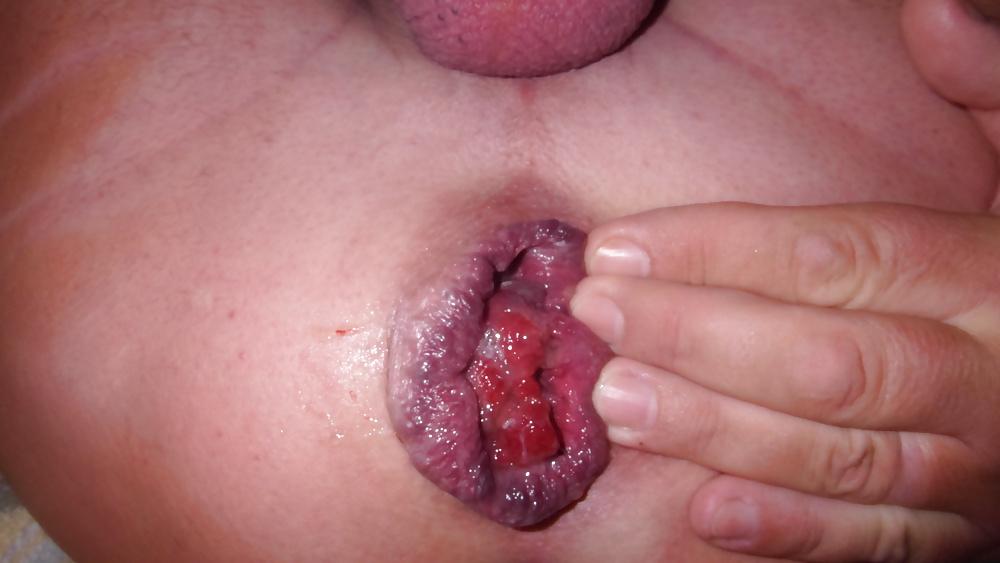 12P Asshole extrem prolapse - Rosebud gape II