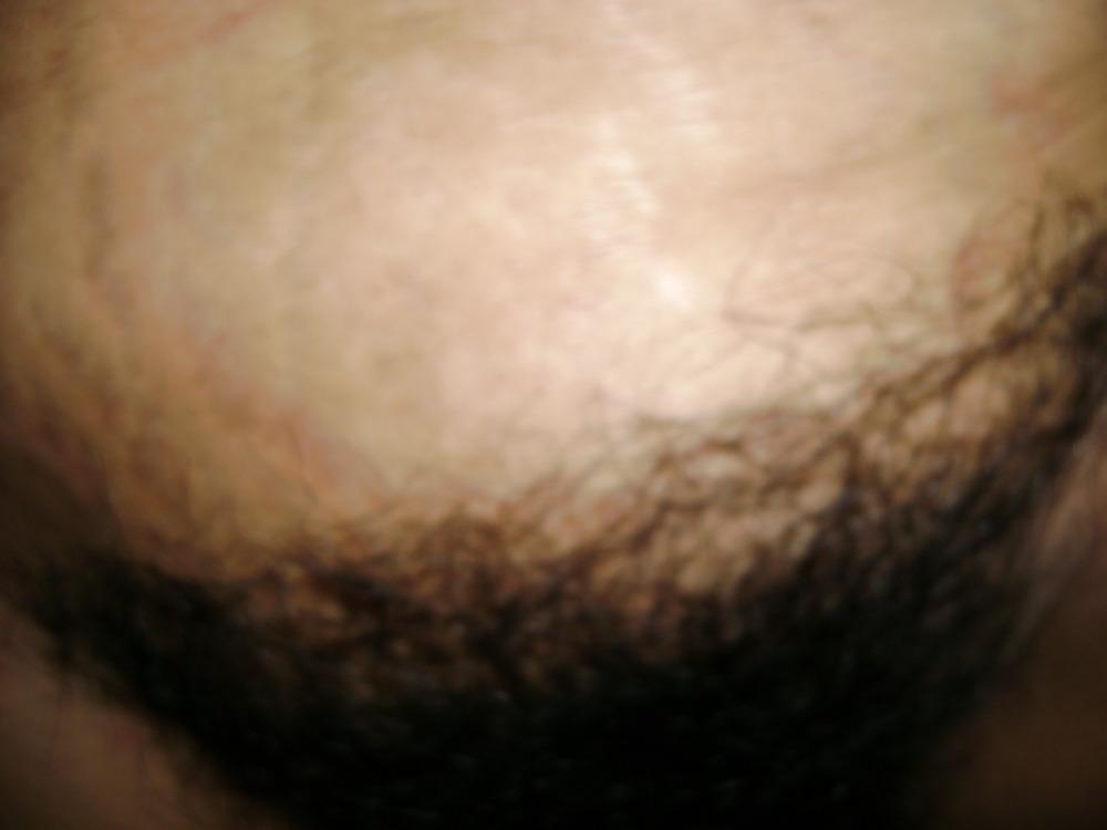 10P Hairy mexican