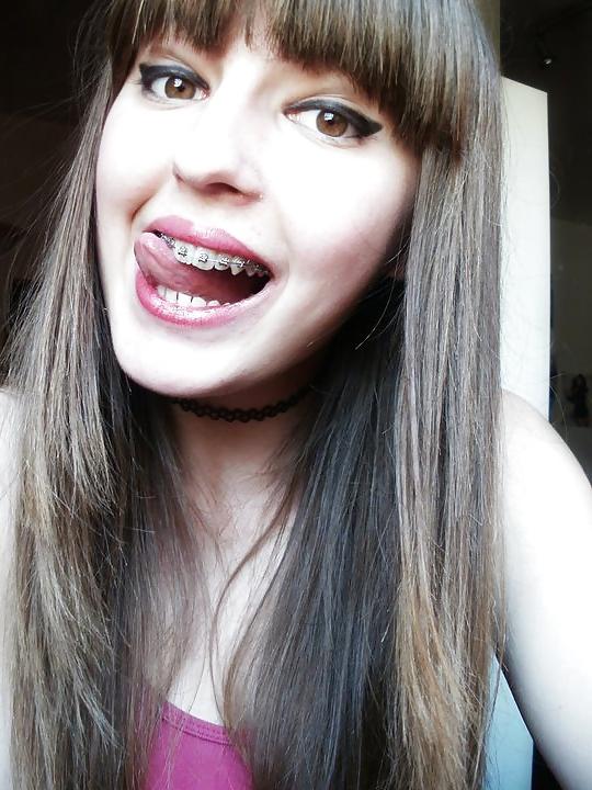 13P Braces