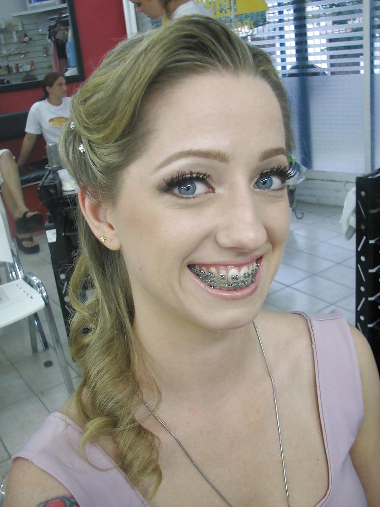 13P Braces