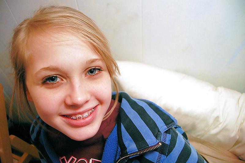 13P Braces