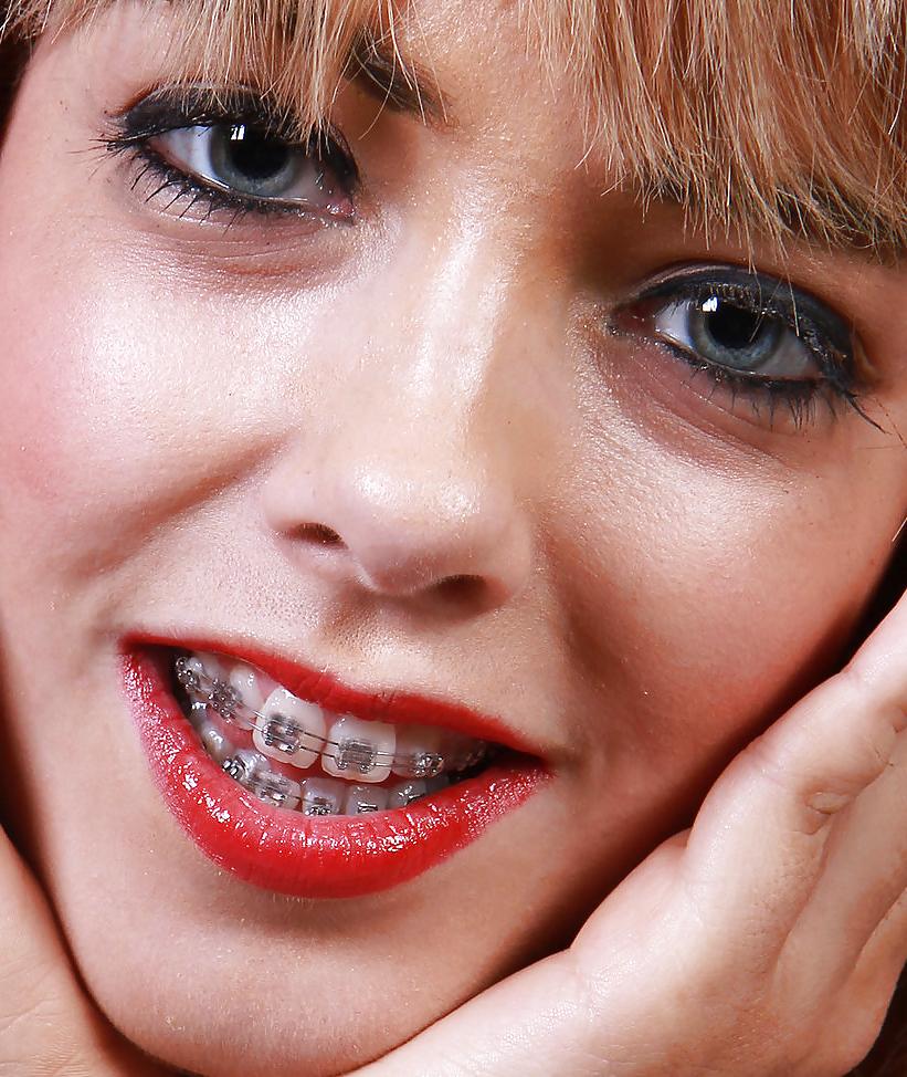 13P Braces
