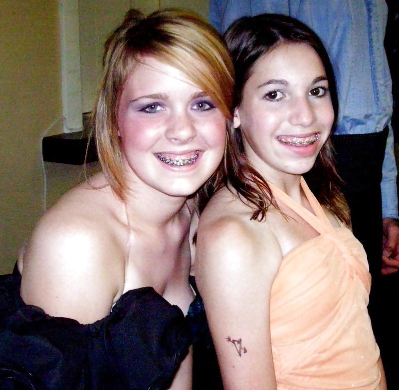 13P Braces