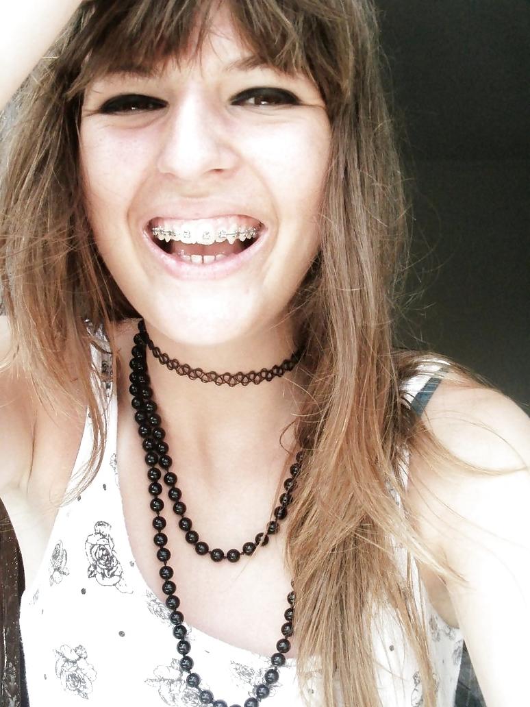 13P Braces