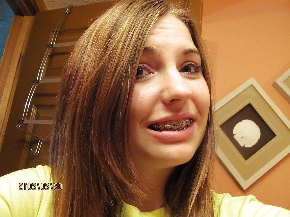13P Braces