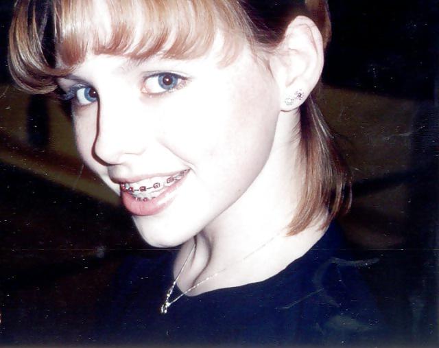 13P Braces
