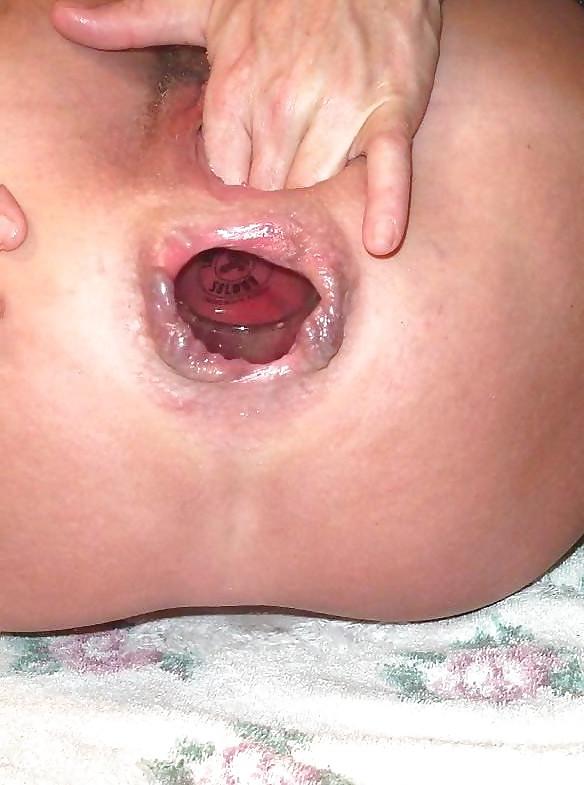 25P Prolapse and gape