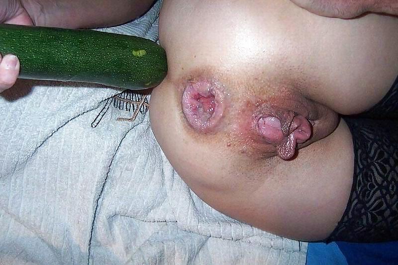 25P Prolapse and gape